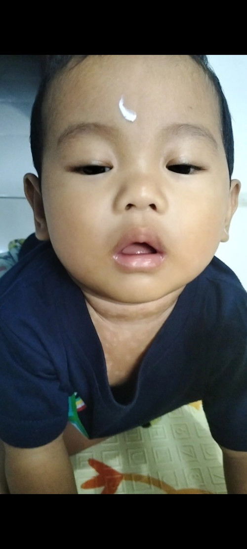 Obat/salep untuk menghilangkan bekas biang keringat