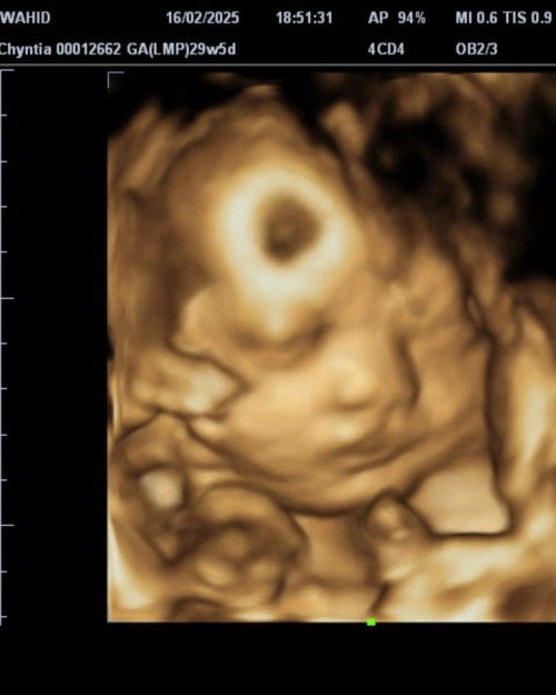 Cara biar bisa lahiran normal gmna yah bund