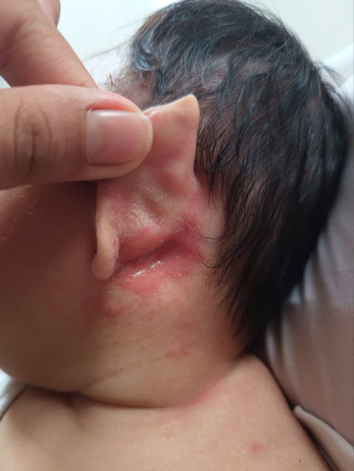 irritated skin- likod ng tenga