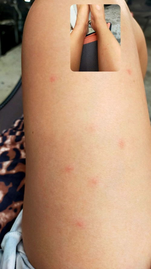 เม็ดขึ้นแบบนี้ อันตรายไหมคะ
แต่มีอาการคันค่ะ แบบนี้ควรไปพบแพทย์ได้ไหมคะ