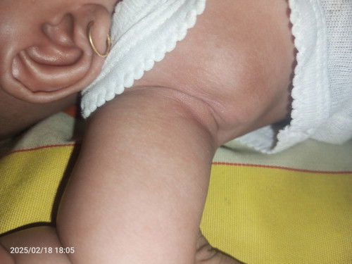 Ketiak bayi ada benjolan