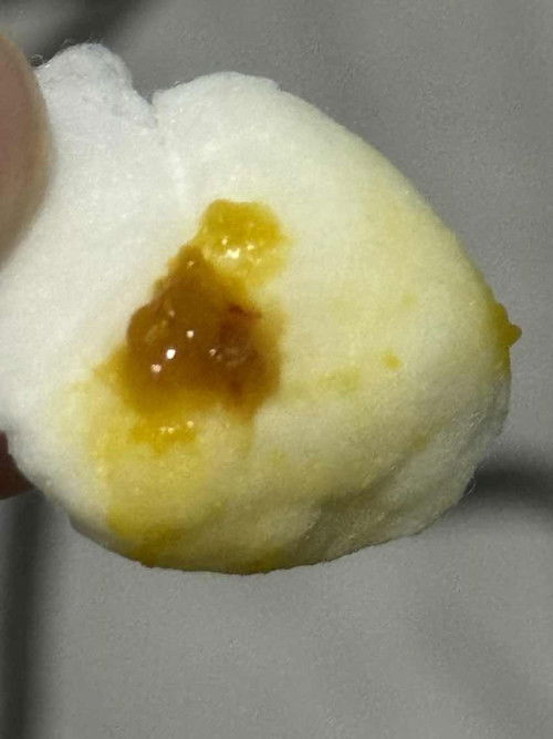 Blood streak sa poop ni LO (6 mos first time sa food purees)