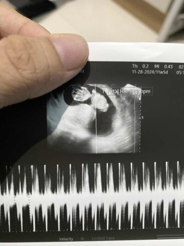 Contraction at 11 weeks