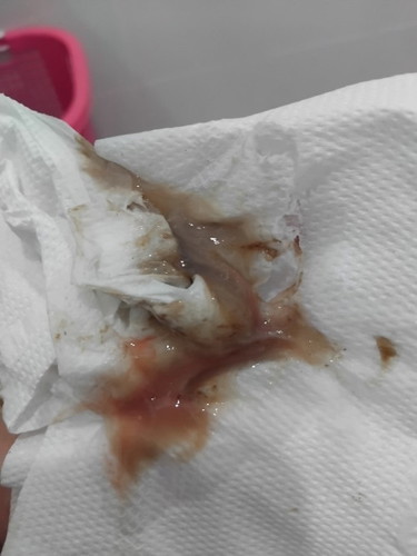 อันนี้คือมูกเลือดไหมคะ