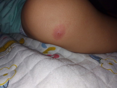 Pula sa tuhod ni baby