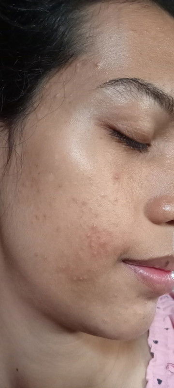 Hamil 16w masih bruntusan parah