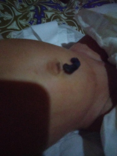 สายสะดือหลุด