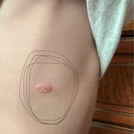 Bé bị nổi sườn bên phải