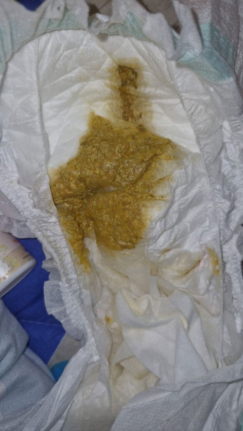 น้องกินนมแม่ ถ่ายแบบนี้ปกติไหมคะ