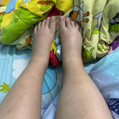 เท้าบวมแบบนี้ปกติไหมคะ