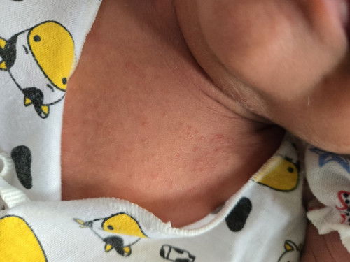 แบบนี้น้องเป็น ผดผื่น หรือ แพ้ อะไรคะ