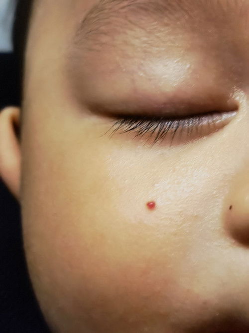 Tahi lalat merah di muka baby.