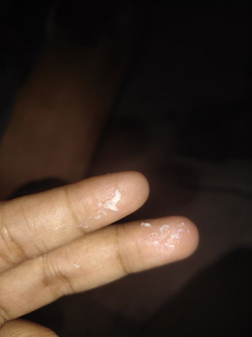 Keputihan apa obatnya