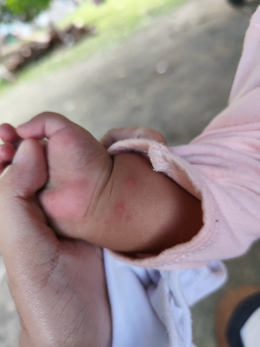 Butlig sa kamay at paa ni baby.