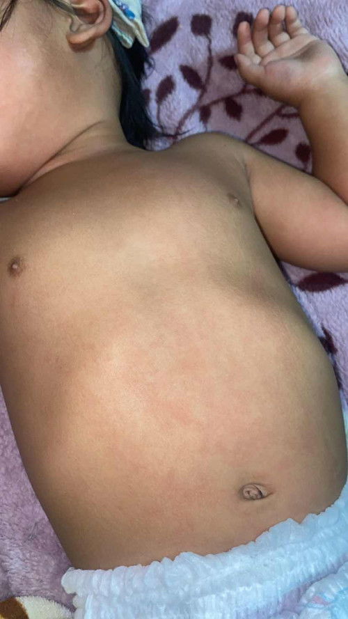 ลูกมีไข้สูงหลังจากฉีดวัคซีน