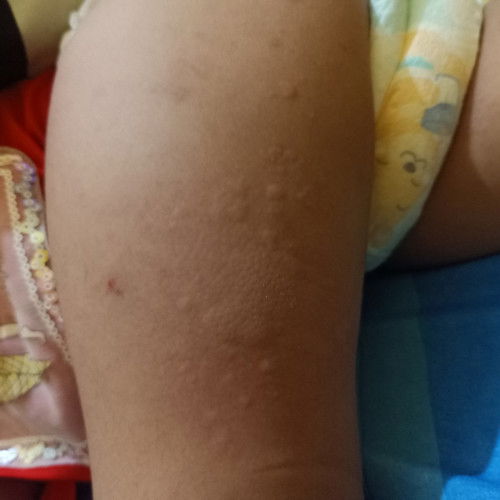 gatal pada anak usia 2 tahun setengah