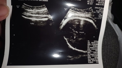 Bun, adakah di sini yang FL janinnya lebih rendah dari usia kandungan? Apakah normal mundur 4weeks?