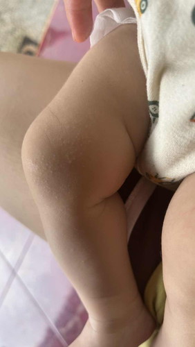 kulit bayi bintik bintik