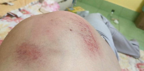 ตั้งครรภ์ได้ 34+4วันแล้วค่ะแต่คันท้องมาก