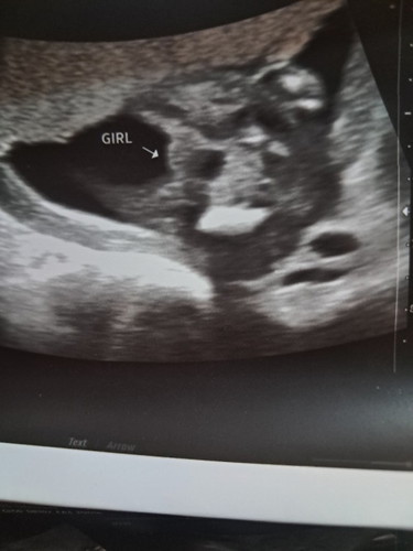 hello po, pa confirm po baby girl po ba talaga siya? thanks po ๐