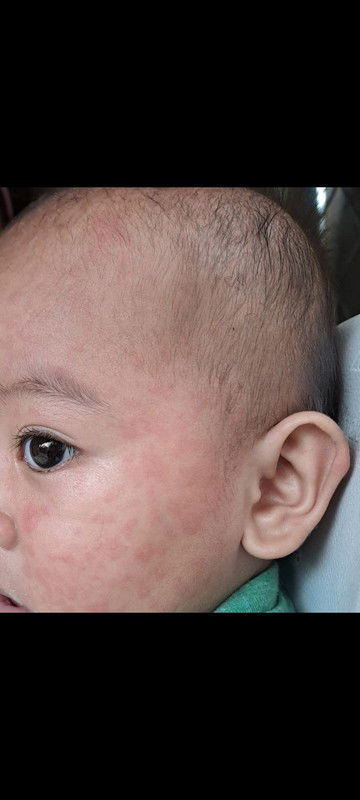 Bintik bintik di muka