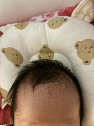 ลูกมีผื่นวงๆแบบนี้ คือผื่นอะไรค่ะรักษายังไงค่ะ