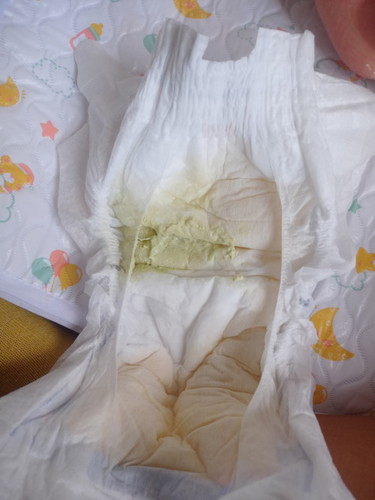 Normal Po Yung ganitong kulay Ng poop ni baby ? Newborn 6days old