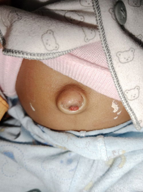 Pusar ada benjolan merah