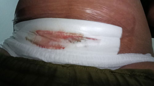 Pasca melahirkan sesar