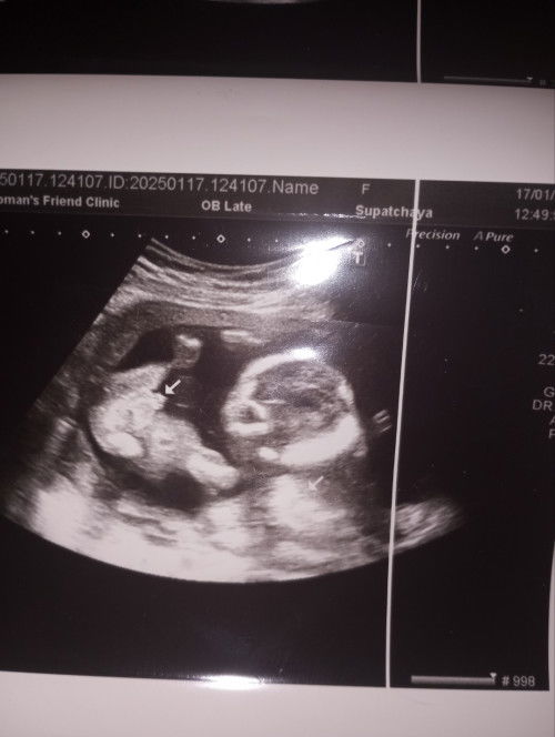 แม่ๆได้ลูกสาวรึลูกชายกันคะ