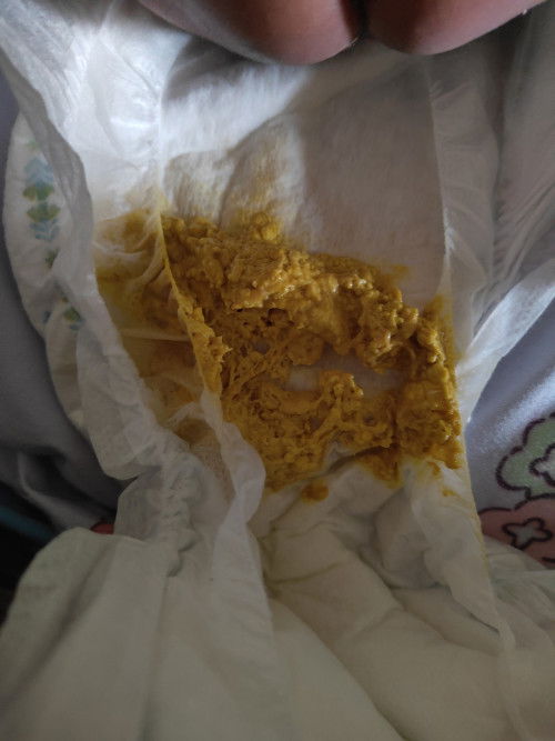 ลูกถ่ายแบบนี้ปกติไหมคะ