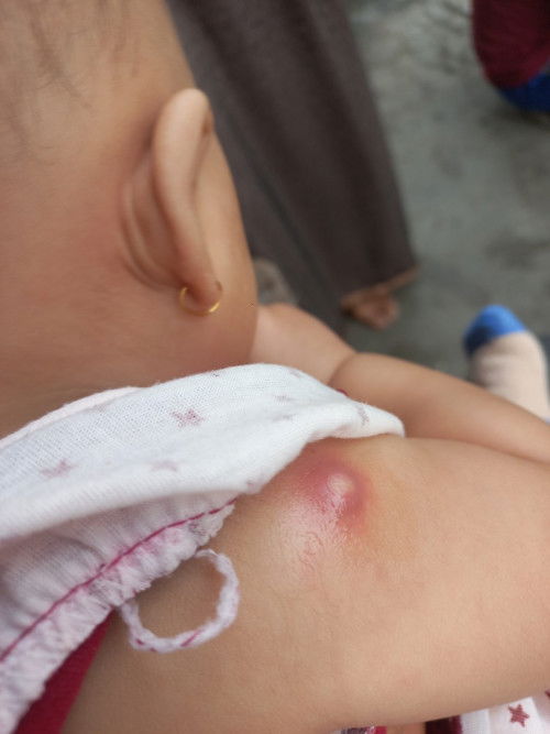 Bekas sumtik imunisasi pertama