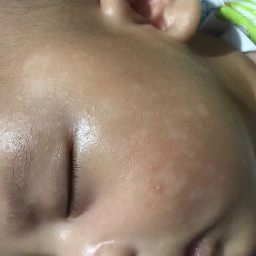 Putih putih di wajah bayi