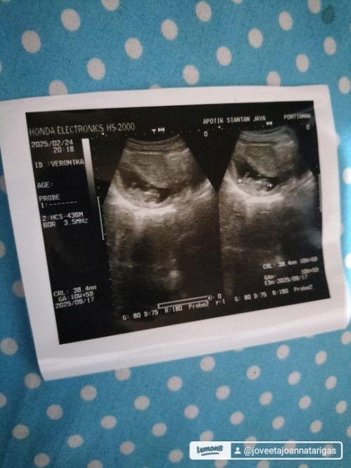 First time USG usia 10week 5day