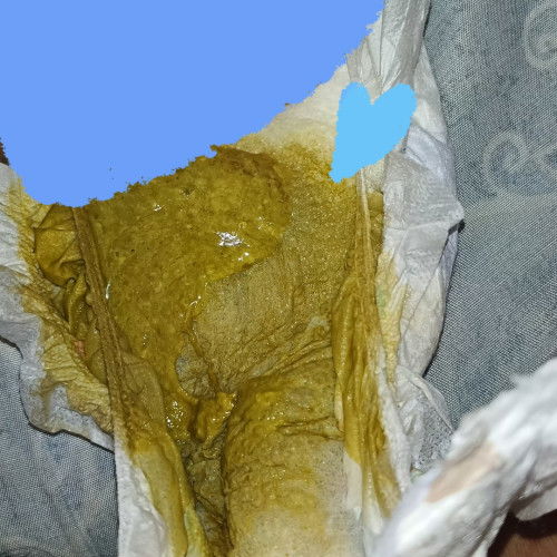 PO*P REACTION TO FORMULA MILK