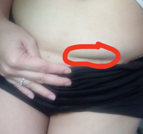 Cesareanmom