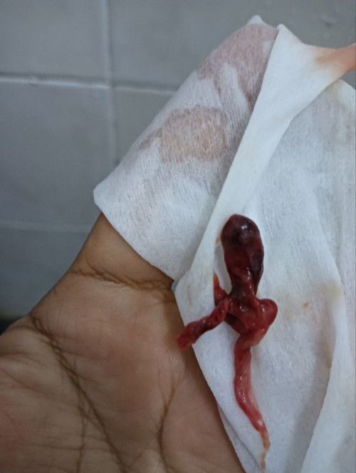 Kalau ikut sy dah 8 weeks. Tp darah turun. Keesokan hr scan rahim kosong. Kemudian keluar ketul dara