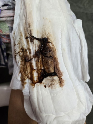 1 day post membrane sweep - discharge or mucus plug?