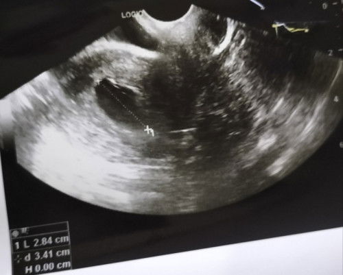 Kehamilan kosong / Hamil BO (Blighted Ovum)