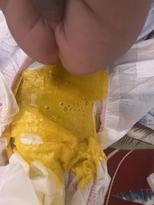 Foamy baby poop