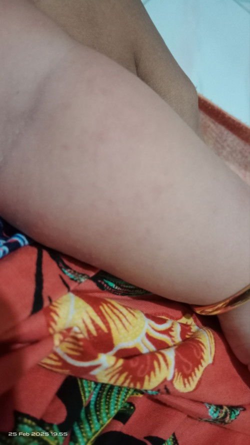 Bun ini apa yaaa biang keringat atau apa aku cek ke dr katanya biang keringat tapi kok banyak