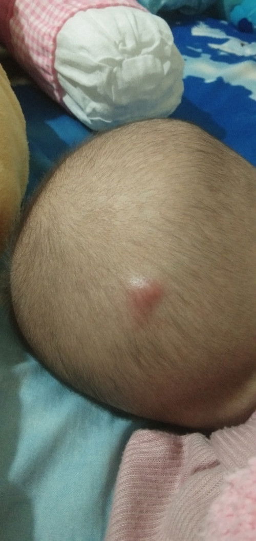 Bentol yang bikin bayik kesakitan di belakang kepala, gak tau di gigit serangga gak tau semacam apa