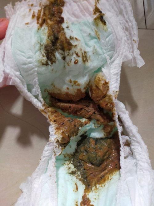 Bun, ini pup anak normal ga yaa? Udah mpasi