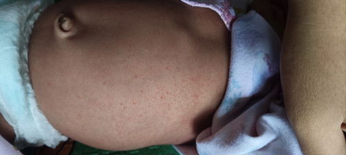 Beruntusan Ruam di Badan