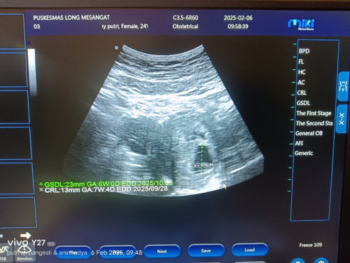 Ini bun beda.a jauh banget klok di aplksi ini 6 feb itu 13 mngg klok usg 7 mngg