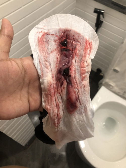 สอบถามหน่อยค่ะแม่ๆ แบบนี้ใช่แท้งไหมคะ