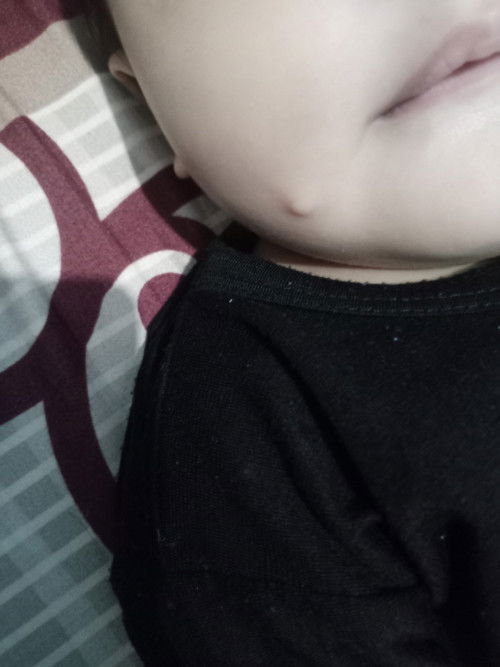 Bentol muka dr lahir