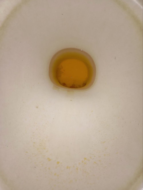 Ano po ang ibig sabihin ng ganyang kulay po ng ihi ko simula po nung naglbm po ako nung isang araw