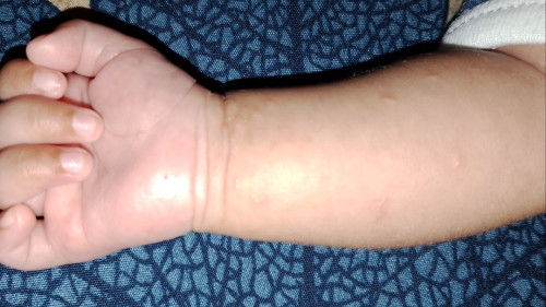 Kulit bayi seperti di foto kenapa yaa, gatal atau cacar yaa