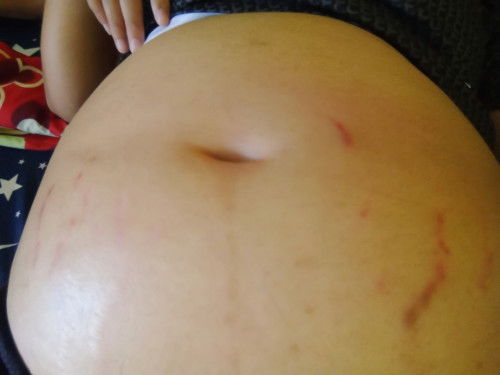 ท้องแตกลาย